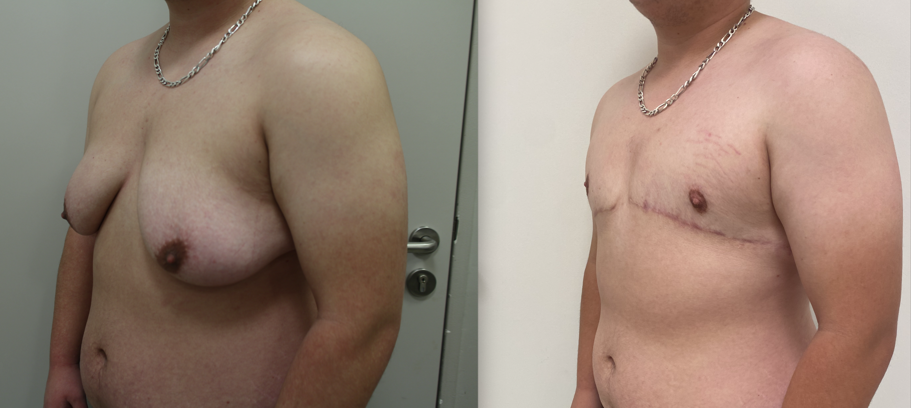 Avant/Après gynecomastie et torsoplastie